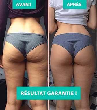 découvrez les principales causes de la culotte de cheval et explorez des solutions efficaces pour la réduire, alliant conseils nutritionnels, exercices ciblés et astuces beauté.